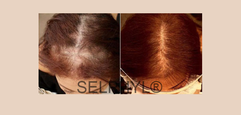 prp hair injections long island